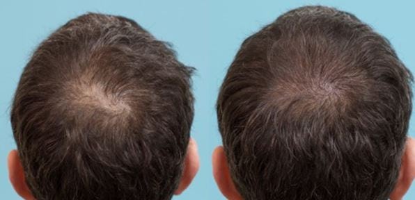Crown Hair Loss Thickening