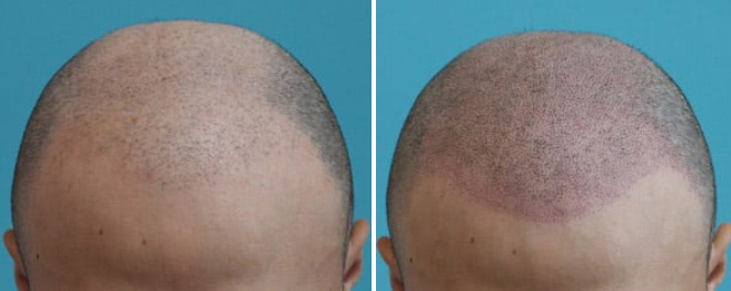 Shaved head hairline restoration