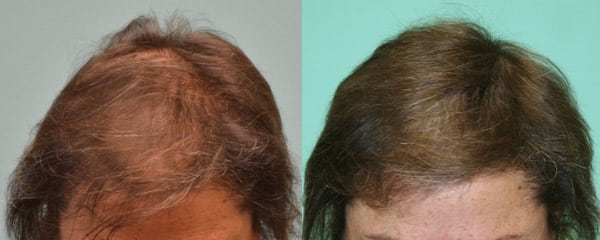 Female Hair Thickening with SMP