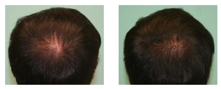 Crown Hair Loss Thickening